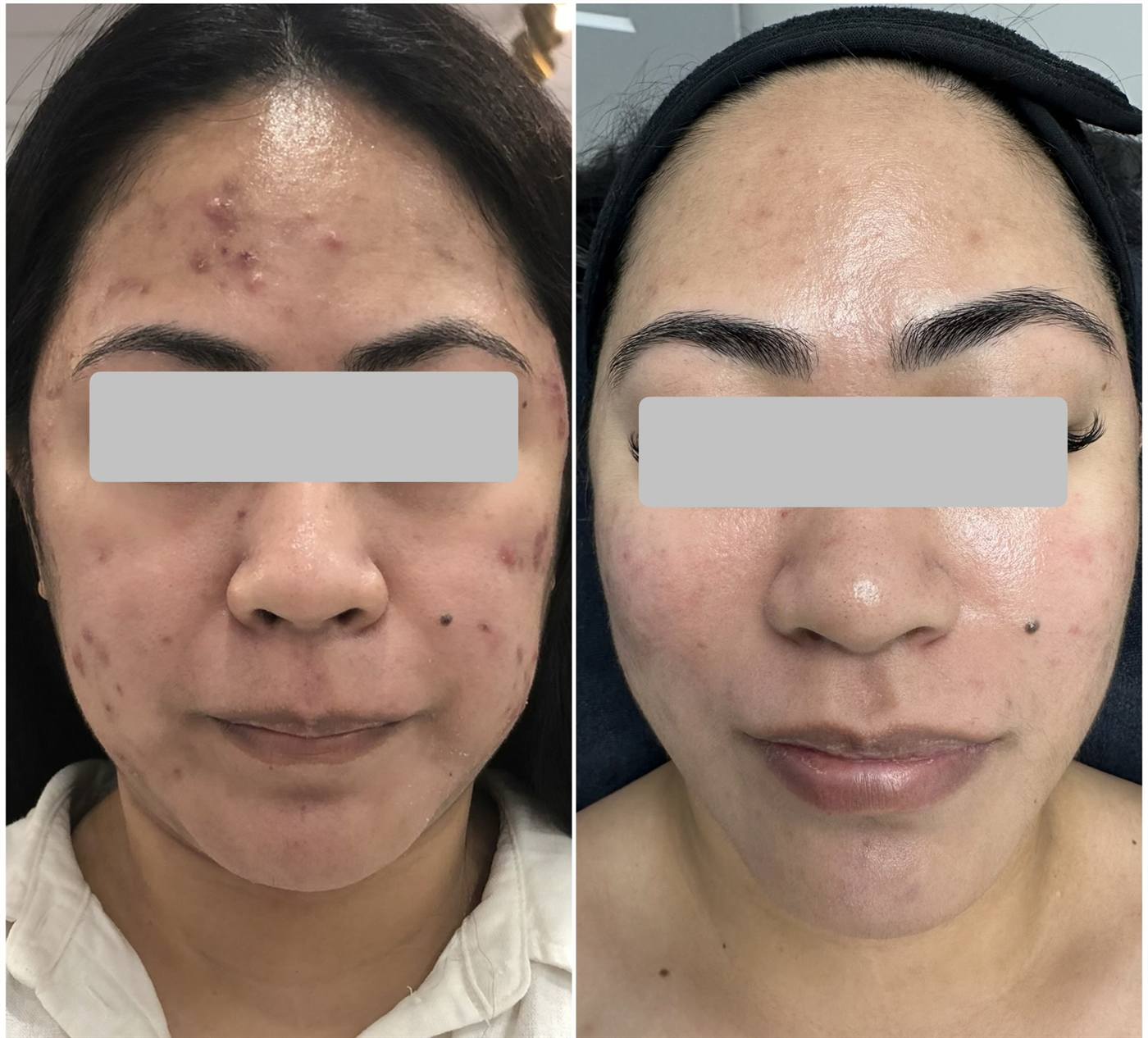 Acne laser treatment before and after — real JuvyDerm client in Calgary