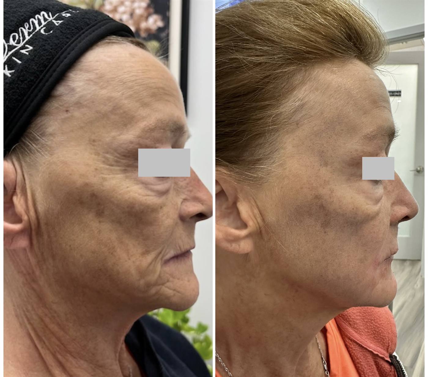 Alma Hybrid laser skin rejuvenation before and after — real JuvyDerm client in Calgary