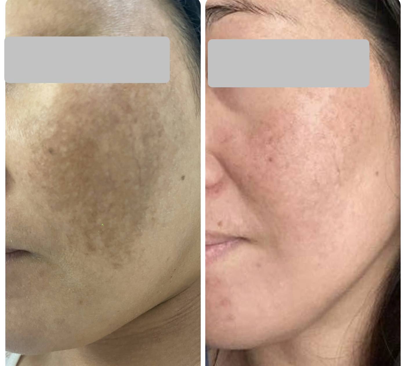 Melasma laser treatment before and after — real JuvyDerm client in Calgary